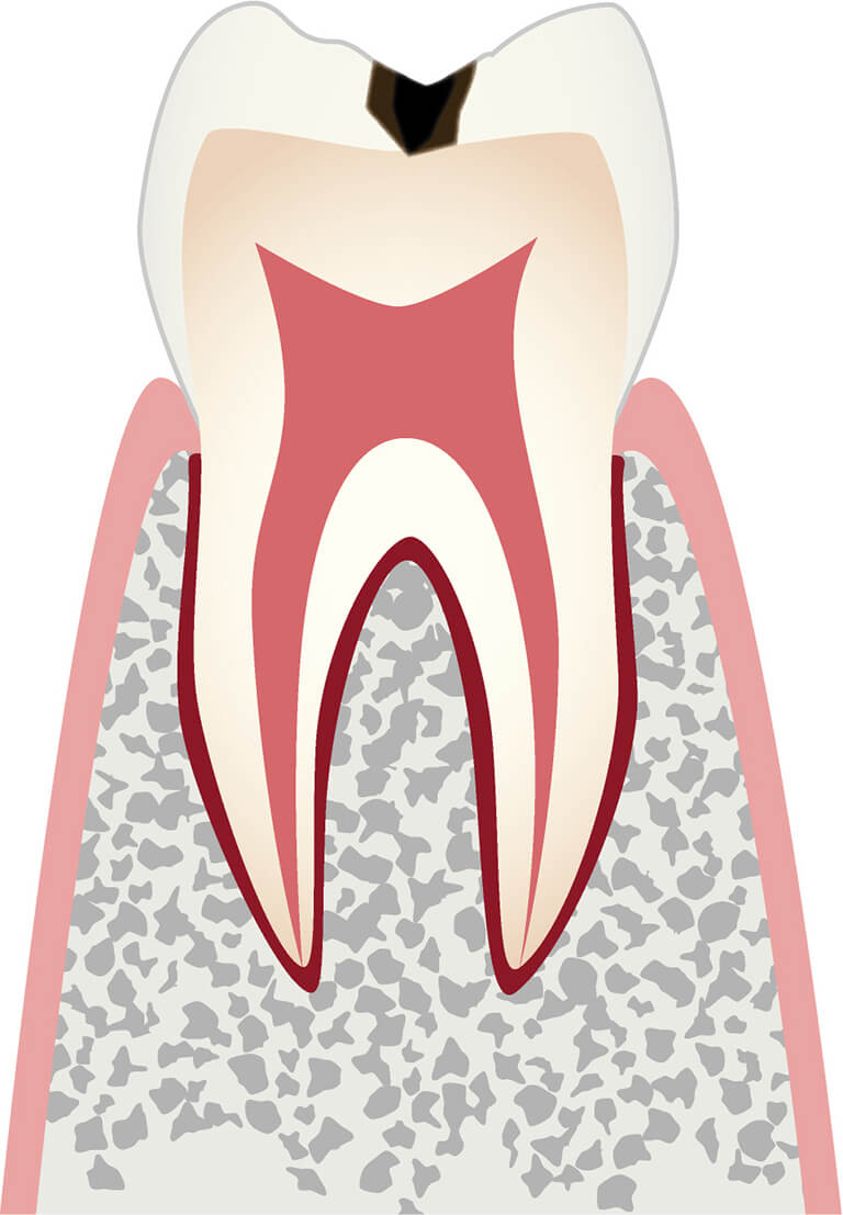 エナメル質に小さな穴が空いたむし歯