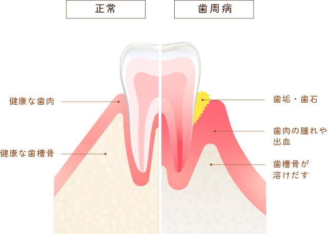 正常状態と歯周病状態の違いのイラスト