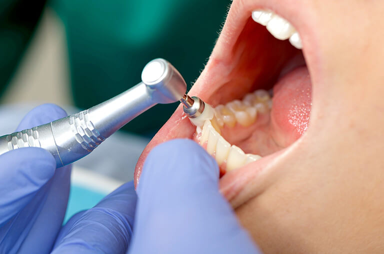 予防歯科とは